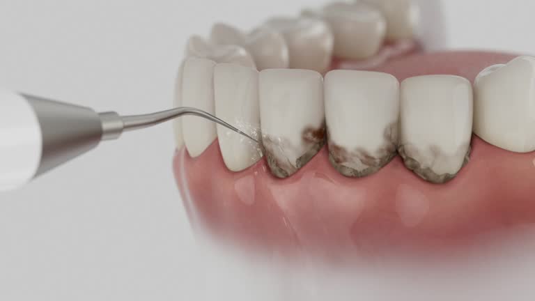 Reliable Dental Implants contractor in Salem, MA by Smile Center Dentistry